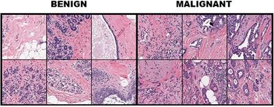 Image Descriptors for Weakly Annotated Histopathological Breast Cancer Data